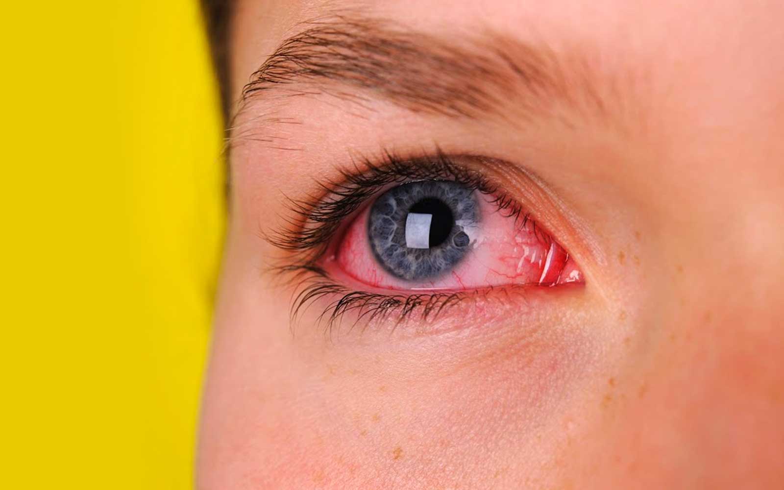 ¿Por qué se ponen los ojos rojos al fumar?